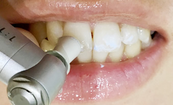 歯の表面をクリーニング